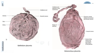 medicoseacademics@gmail.com
0310-7990649
Battledore placenta
Velamentous placenta
 