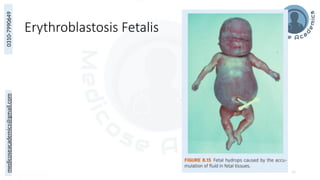 medicoseacademics@gmail.com
0310-7990649
Erythroblastosis Fetalis
39
 