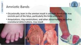medicoseacademics@gmail.com
0310-7990649
Amniotic Bands
• Occasionally, tears in the amnion result in amniotic bands that may
encircle part of the fetus, particularly the limbs and digits
• Amputations, ring constrictions, and other abnormalities, including
craniofacial deformations, may result
51
 