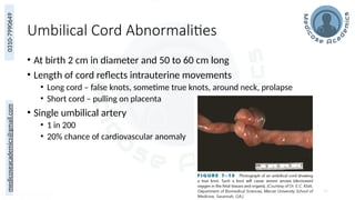 medicoseacademics@gmail.com
0310-7990649
Umbilical Cord Abnormalities
• At birth 2 cm in diameter and 50 to 60 cm long
• Length of cord reflects intrauterine movements
• Long cord – false knots, sometime true knots, around neck, prolapse
• Short cord – pulling on placenta
• Single umbilical artery
• 1 in 200
• 20% chance of cardiovascular anomaly
75
 