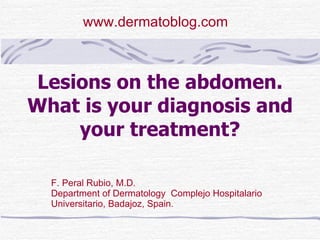 Lesions on the abdomen. What is your diagnosis and your treatment? F. Peral Rubio, M.D. Department of Dermatology  Complejo Hospitalario Universitario, Badajoz, Spain. www.dermatoblog.com  