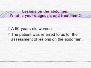 Lesions on the abdomen.
What is your diagnosis and treatment?
A 50-years-old women.
The patient was referred to us for the
assessment of lesions on the abdomen.
 