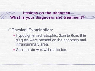 Lesions on the abdomen.
What is your diagnosis and treatment?
Physical Examination:
Hypopigmented, atrophic, 3cm to 6cm, thin
plaques were present on the abdomen and
inframammary area.
Genital skin was without lesion.
 