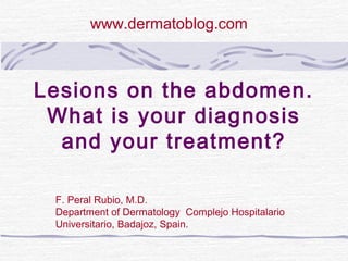 Lesions on the abdomen.
What is your diagnosis
and your treatment?
F. Peral Rubio, M.D.
Department of Dermatology Complejo Hospitalario
Universitario, Badajoz, Spain.
www.dermatoblog.com
 