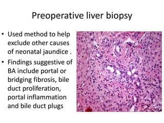 Preoperative liver biopsy
• Used method to help
exclude other causes
of neonatal jaundice .
• Findings suggestive of
BA include portal or
bridging fibrosis, bile
duct proliferation,
portal inflammation
and bile duct plugs
 