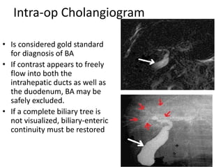 Intra-op Cholangiogram
• Is considered gold standard
for diagnosis of BA
• If contrast appears to freely
flow into both the
intrahepatic ducts as well as
the duodenum, BA may be
safely excluded.
• If a complete biliary tree is
not visualized, biliary-enteric
continuity must be restored
 