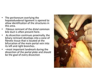 • The peritoneum overlying the
hepatoduodenal ligament is opened to
allow identification of the structures in
this area.
• Fibrous remnant of the distal common
bile duct is often present here.
• As dissection continues proximally, the
biliary remnant develops into a cone of
fibrotic tissue that is located at the
bifurcation of the main portal vein into
its left and right branches.
• –most important landmark during the
dissection of the portal plate and should
be the goal of every dissection
 