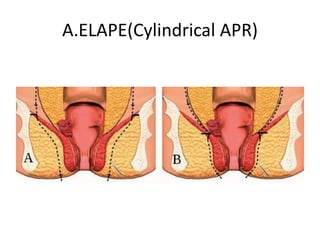 A.ELAPE(Cylindrical APR)
 
