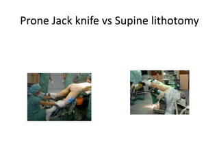Prone Jack knife vs Supine lithotomy
 