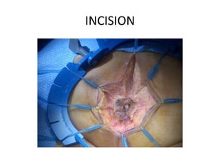 INCISION
 