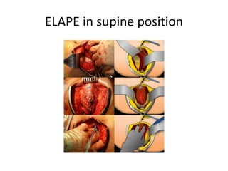 ELAPE in supine position
 