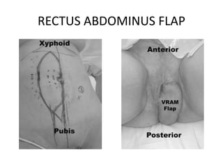 RECTUS ABDOMINUS FLAP
 