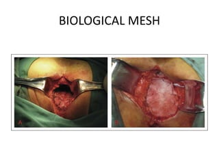 BIOLOGICAL MESH
 