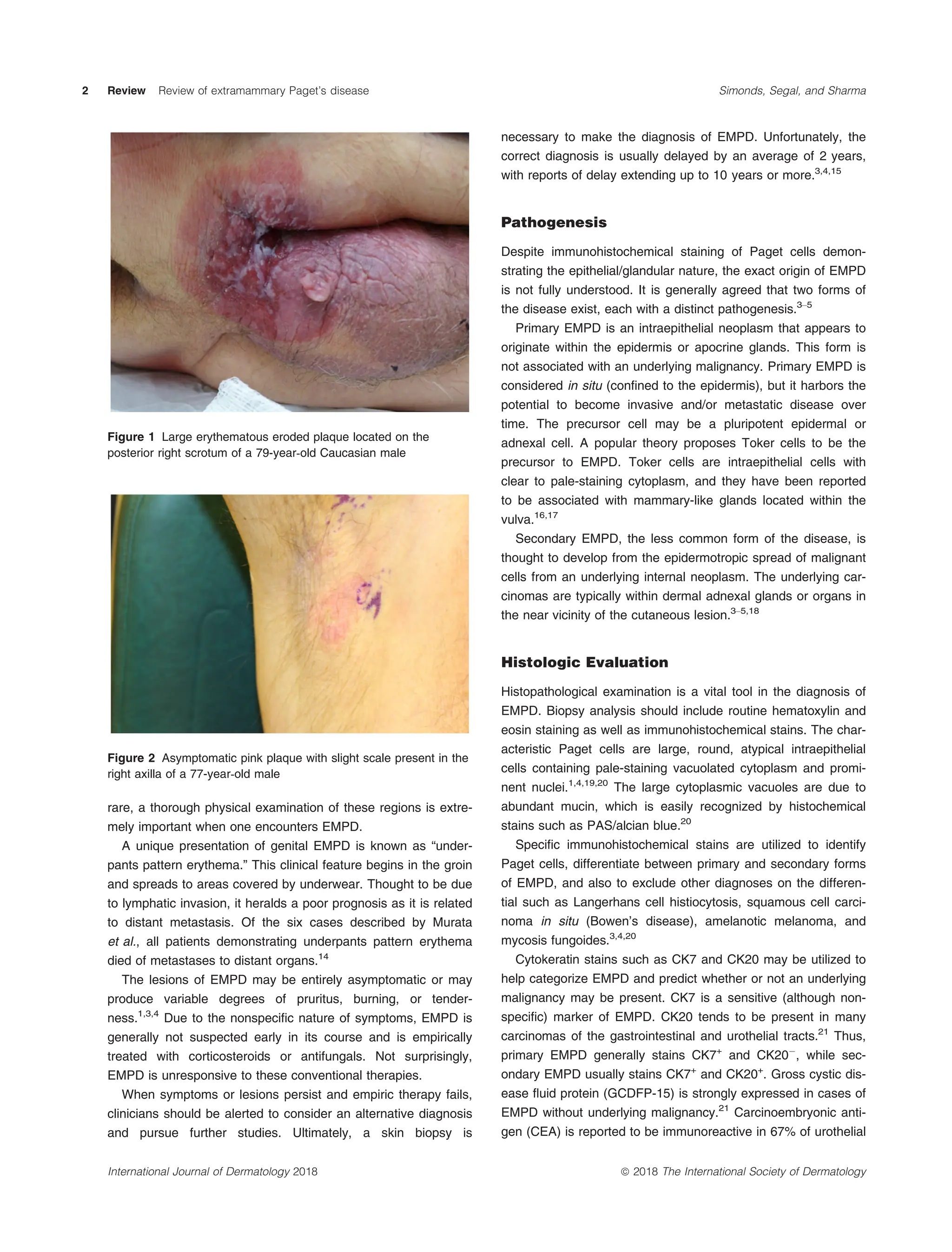 extramammary-paget-s-disease-a-review-of-the-literature-pdf