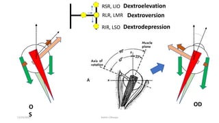 RIR, LSO
RSR, LIO
RLR, LMR
ODO
S
Dextroelevation
Dextrodepression
Dextroversion
12/25/2019 Ashim Chhusya
 