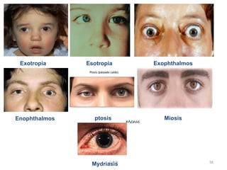 Exotropia Esotropia Exophthalmos
Enophthalmos Miosis
ptosis
Mydriasis
G R N 58
 