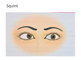 Squint