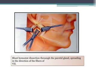 Extraoral mandibular approaches