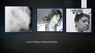 Lateral Oblique Projection-Body
 