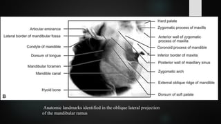 Anatomic landmarks identified in the oblique lateral projection
of the mandibular ramus
 