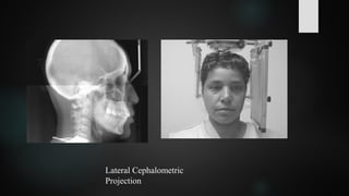 Lateral Cephalometric
Projection
 