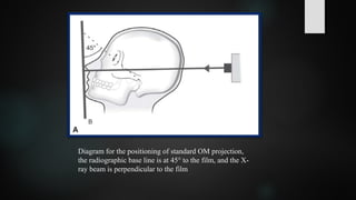 Diagram for the positioning of standard OM projection,
the radiographic base line is at 45° to the film, and the X-
ray beam is perpendicular to the film
 
