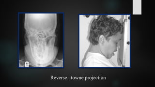 Reverse –towne projection
 