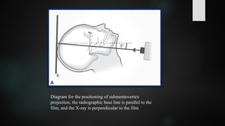 Diagram for the positioning of submentovertex
projection, the radiographic base line is parallel to the
film, and the X-ray is perpendicular to the film
 
