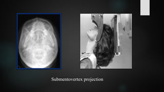 Submentovertex projection
 