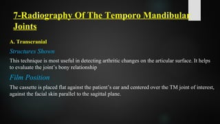 7-Radiography Of The Temporo Mandibular
Joints
A. Transcranial
Structures Shown
This technique is most useful in detecting arthritic changes on the articular surface. It helps
to evaluate the joint’s bony relationship
Film Position
The cassette is placed flat against the patient’s ear and centered over the TM joint of interest,
against the facial skin parallel to the sagittal plane.
 