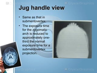 Jug handle viewJug handle view
• Same as that in
submentovertex.
• The exposure time
for the zygomatic
arch is reduced to
approximately one-
third the normal
exposure time for a
submentovertex
projection.
 