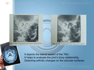 It depicts the lateral aspect of the TMJ.
It helps to evaluate the joint’s bony relationship.
Detecting arthritic changes on the articular surfaces.
 