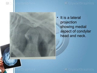 • It is a lateral
projection
showing medial
aspect of condylar
head and neck.
 