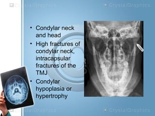 • Condylar neck
and head
• High fractures of
condylar neck,
intracapsular
fractures of the
TMJ
• Condylar
hypoplasia or
hypertrophy
 