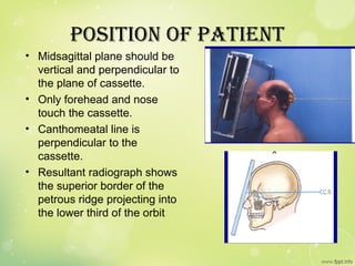 Petrous Ridge Positioning Chart extraoral IMAGING IN OROFCAIL REGION SNUSES | PPT