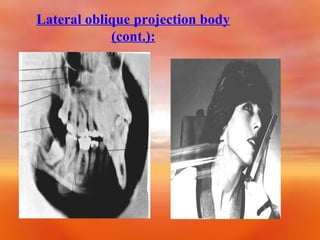 Lateral oblique projection body
(cont.):

 