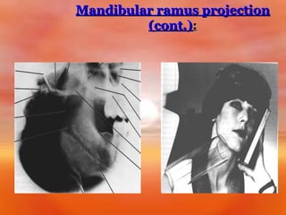 Mandibular ramus projection
(cont.):

 