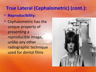 True Lateral (Cephalometric) (cont.):
• Reproducibility:
• Cephalometric has the
unique property of
presenting a
reproducible image,
unlike any other
radiographic technique
used for dental films

 