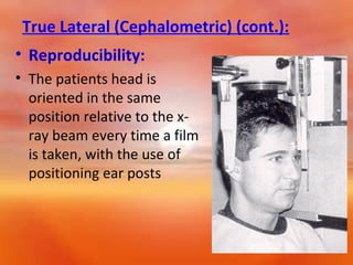 True Lateral (Cephalometric) (cont.):
• Reproducibility:
• The patients head is
oriented in the same
position relative to the xray beam every time a film
is taken, with the use of
positioning ear posts

 