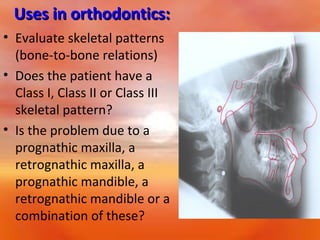 Uses in orthodontics:
• Evaluate skeletal patterns
(bone-to-bone relations)
• Does the patient have a
Class I, Class II or Class III
skeletal pattern?
• Is the problem due to a
prognathic maxilla, a
retrognathic maxilla, a
prognathic mandible, a
retrognathic mandible or a
combination of these?

 