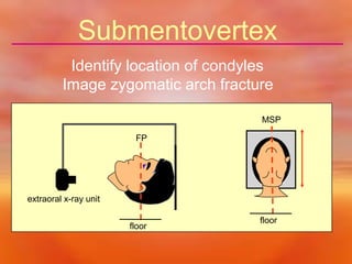 Submentovertex
Identify location of condyles
Image zygomatic arch fracture
MSP
FP

extraoral x-ray unit
floor

floor

 
