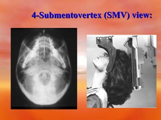 4-Submentovertex (SMV) view:

 