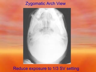 Zygomatic Arch View

Reduce exposure to 1/3 SV setting

 