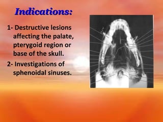 Indications:
1- Destructive lesions
affecting the palate,
pterygoid region or
base of the skull.
2- Investigations of
sphenoidal sinuses.

 