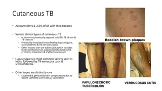 Scrofuloderma Presentation Extrapulmonary Tuberculosis_SRP.....pptx