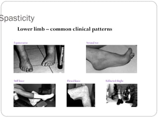 Spasticity
Lower limb – common clinical patterns
Equinovarus Striatal toe
Stiff knee Flexed knee Adducted thighs
 