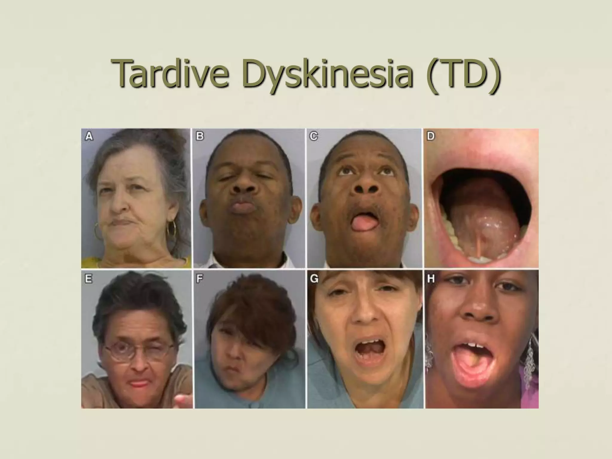 Tardive Dyskinesia (TD)
 