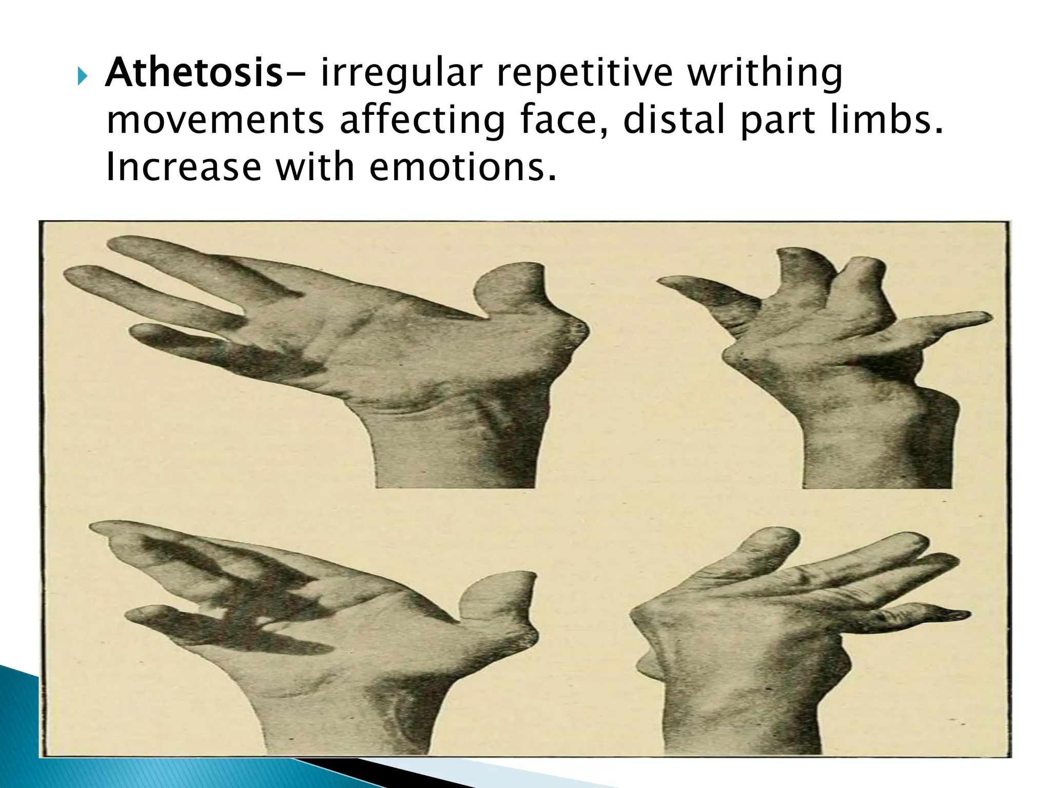  Athetosis- irregular repetitive writhing
movements affecting face, distal part limbs.
Increase with emotions.
 