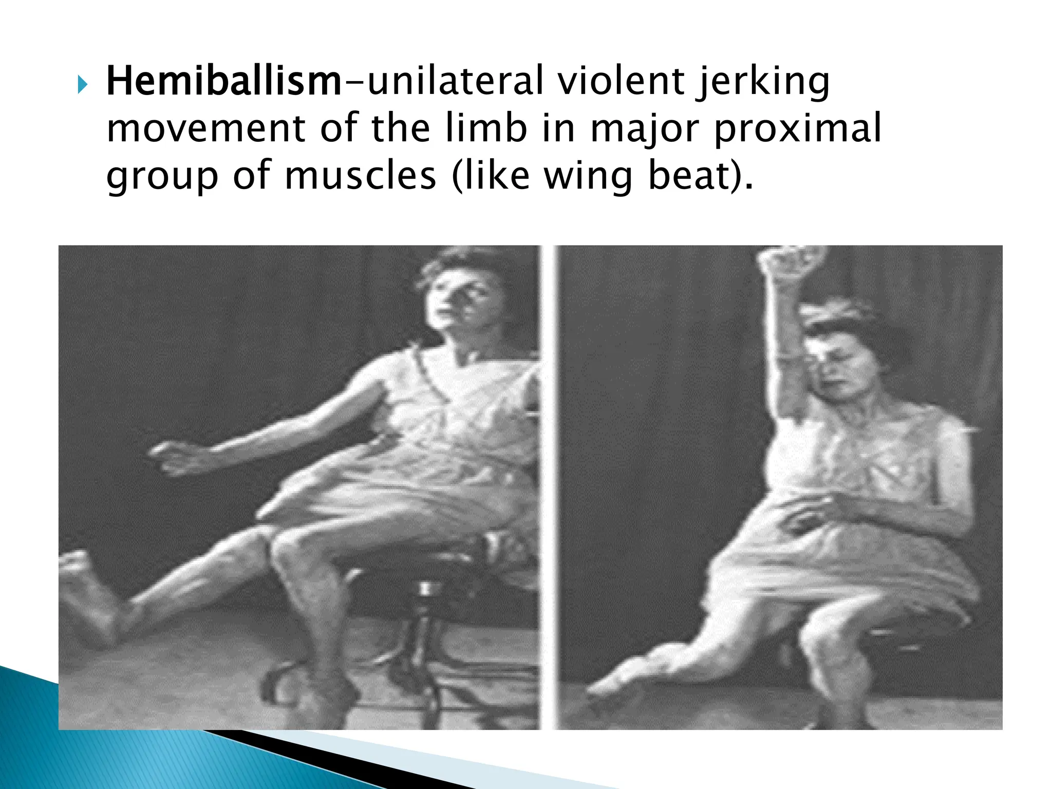  Hemiballism-unilateral violent jerking
movement of the limb in major proximal
group of muscles (like wing beat).
 