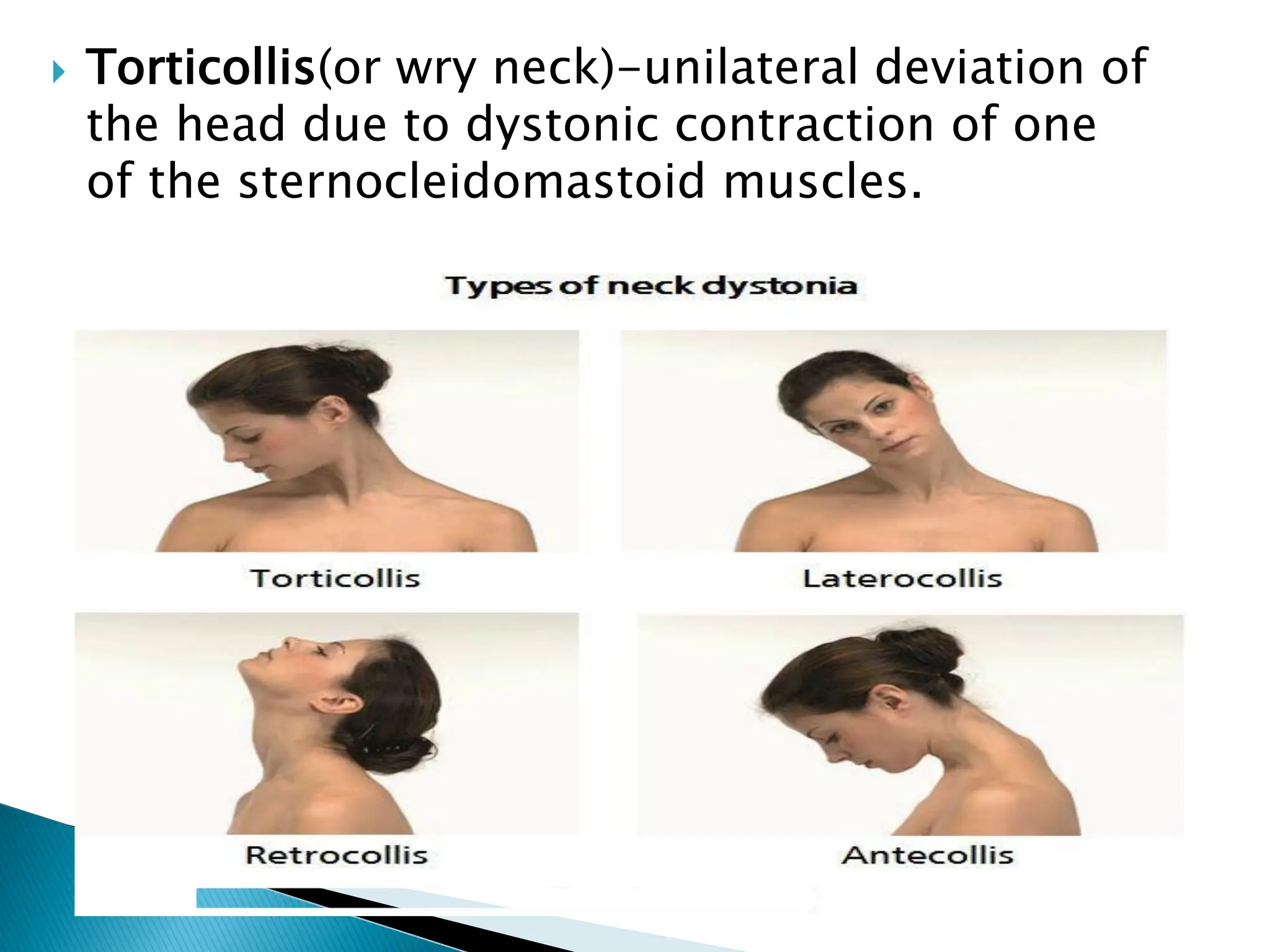  Torticollis(or wry neck)-unilateral deviation of
the head due to dystonic contraction of one
of the sternocleidomastoid muscles.
 